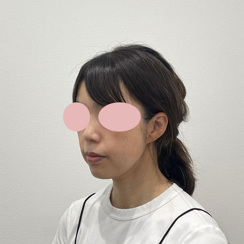 デンシティ＋ウルトラセルQプラス組み合わせ 施術後