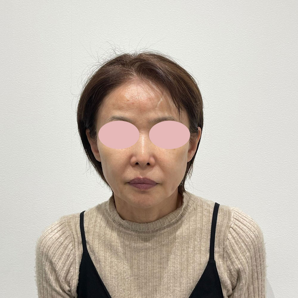 デンシティ全顔 施術後