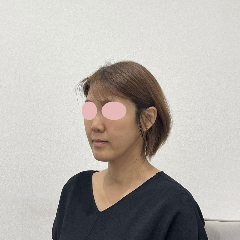 デンシティ＋ウルトラセルQプラス組み合わせ 施術後