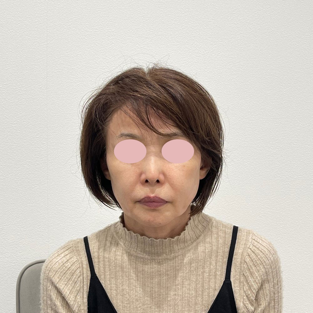 デンシティ全顔 施術前