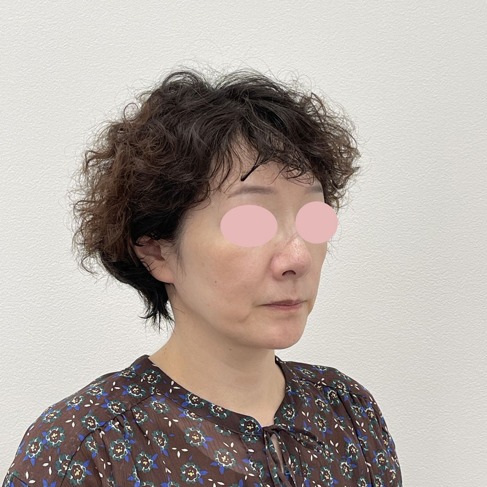 デンシティ全顔 施術前