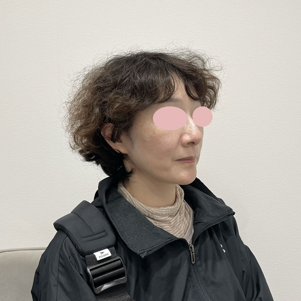 デンシティ全顔 施術後