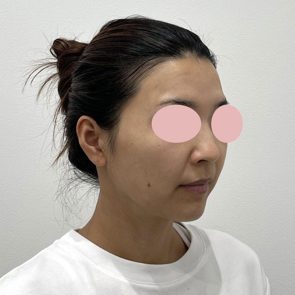 デンシティ全顔 施術前