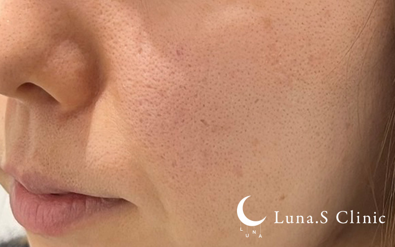 ポテンツァ ドラックデリバリー マックーム  施術前