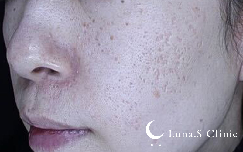 ポテンツァ ドラックデリバリー マックーム  施術前