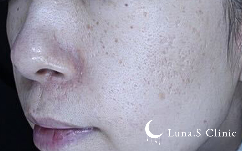 ポテンツァ ドラックデリバリー マックーム  施術後