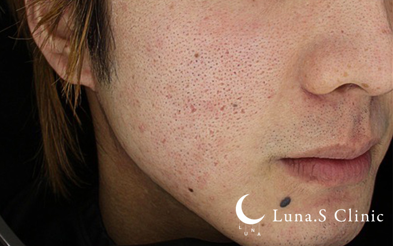 ポテンツァ ドラックデリバリー マックーム  施術前