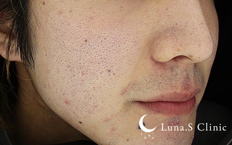 ポテンツァ ドラックデリバリー マックーム  施術後