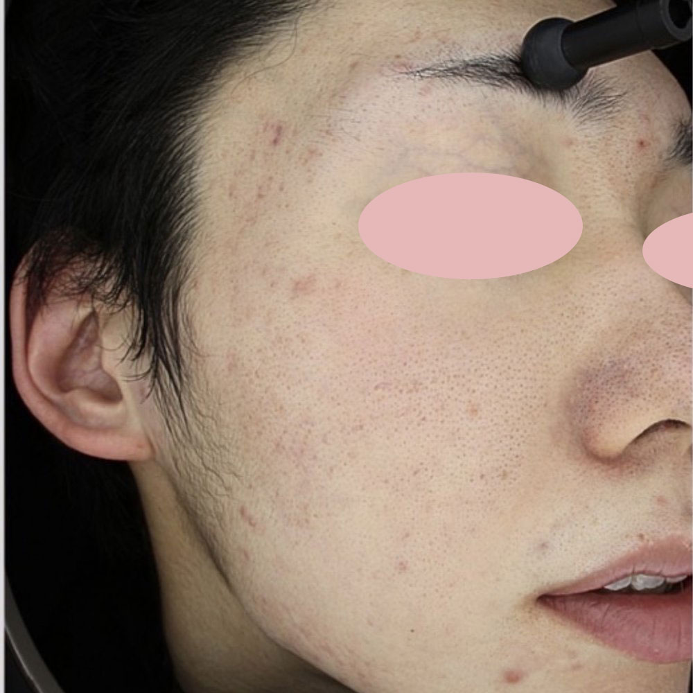 ポテンツァ ドラックデリバリー マックーム  施術後