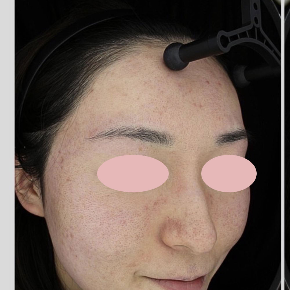 ポテンツァ ドラックデリバリー マックーム  施術前