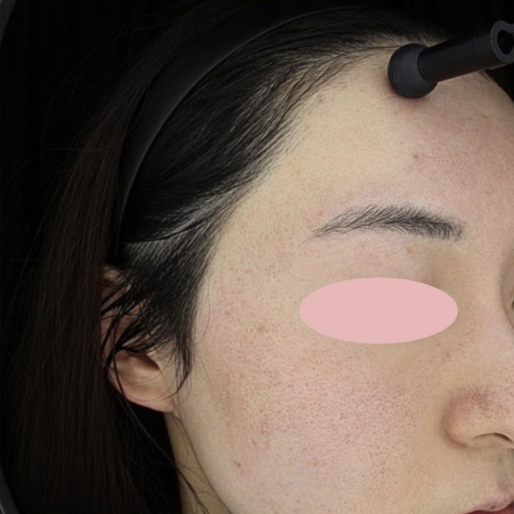 ポテンツァ ドラックデリバリー マックーム  施術後