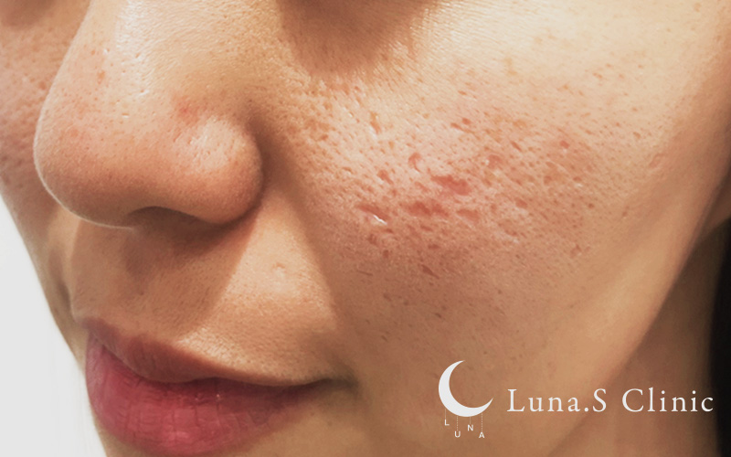 ジュベルック手打ち（クレーター・傷跡 1～10か所まで） 施術前