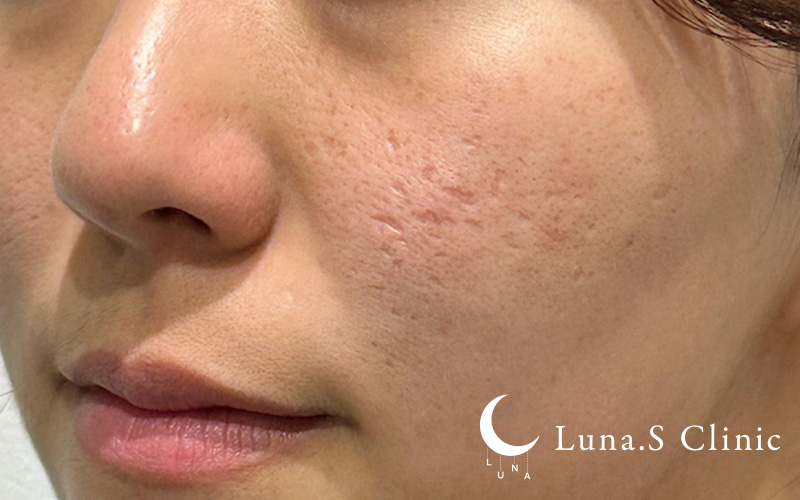 ジュベルック手打ち（クレーター・傷跡 1～10か所まで） 施術後