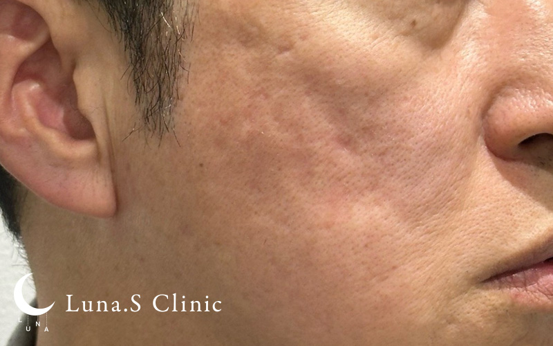 ポテンツァ ドラックデリバリー マックーム+ジュベルック手打ち（クレーター・傷跡1〜10か所まで） 施術前