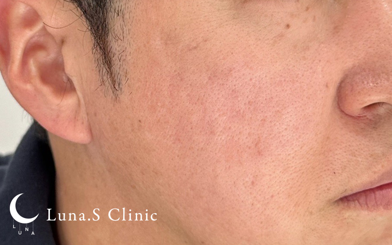 ポテンツァ ドラックデリバリー マックーム+ジュベルック手打ち（クレーター・傷跡1〜10か所まで） 施術後