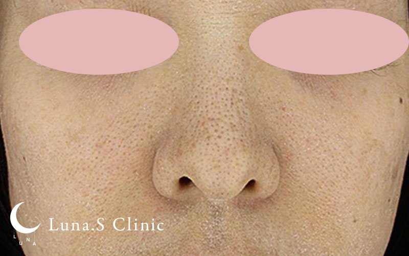 ジュベルック手打ち（全顔） 施術前