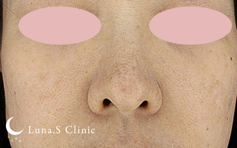 ジュベルック手打ち（全顔） 施術後