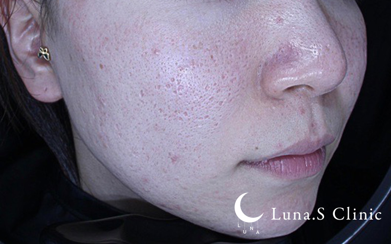 ポテンツァ ドラックデリバリー マックーム +ジュベルック手打ち（両頬から 施術前