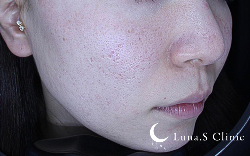 ポテンツァ ドラックデリバリー マックーム +ジュベルック手打ち（両頬から 施術後