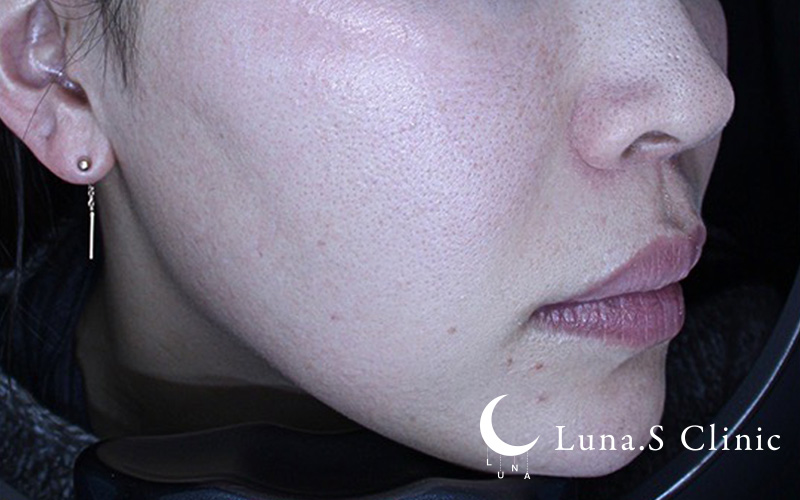 プルリアルデンシファイ（ハイコックス） 施術前