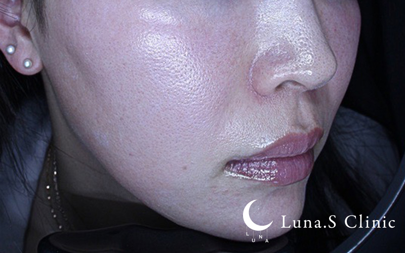 プルリアルデンシファイ（ハイコックス） 施術後