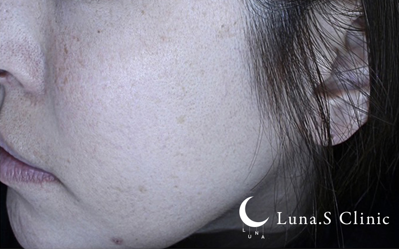 プルリアルデンシファイ（ハイコックス） 施術前