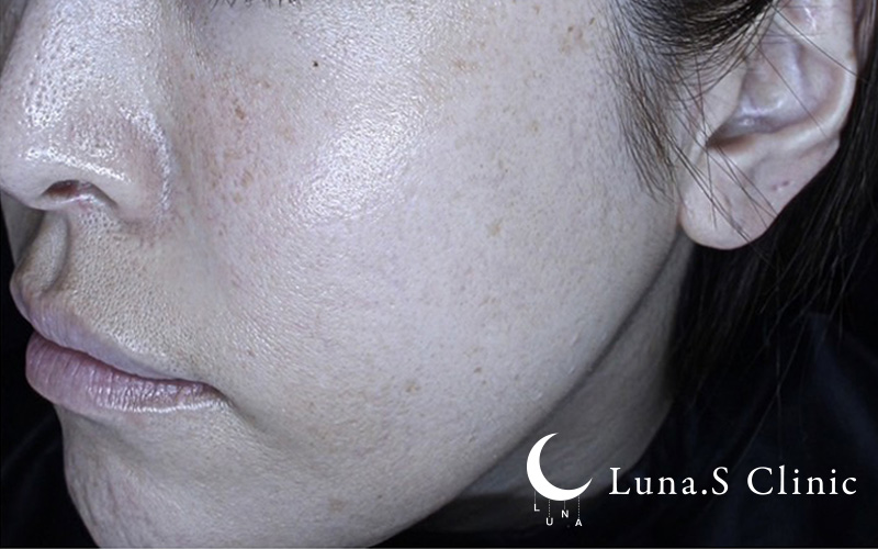 プルリアルデンシファイ（ハイコックス） 施術後