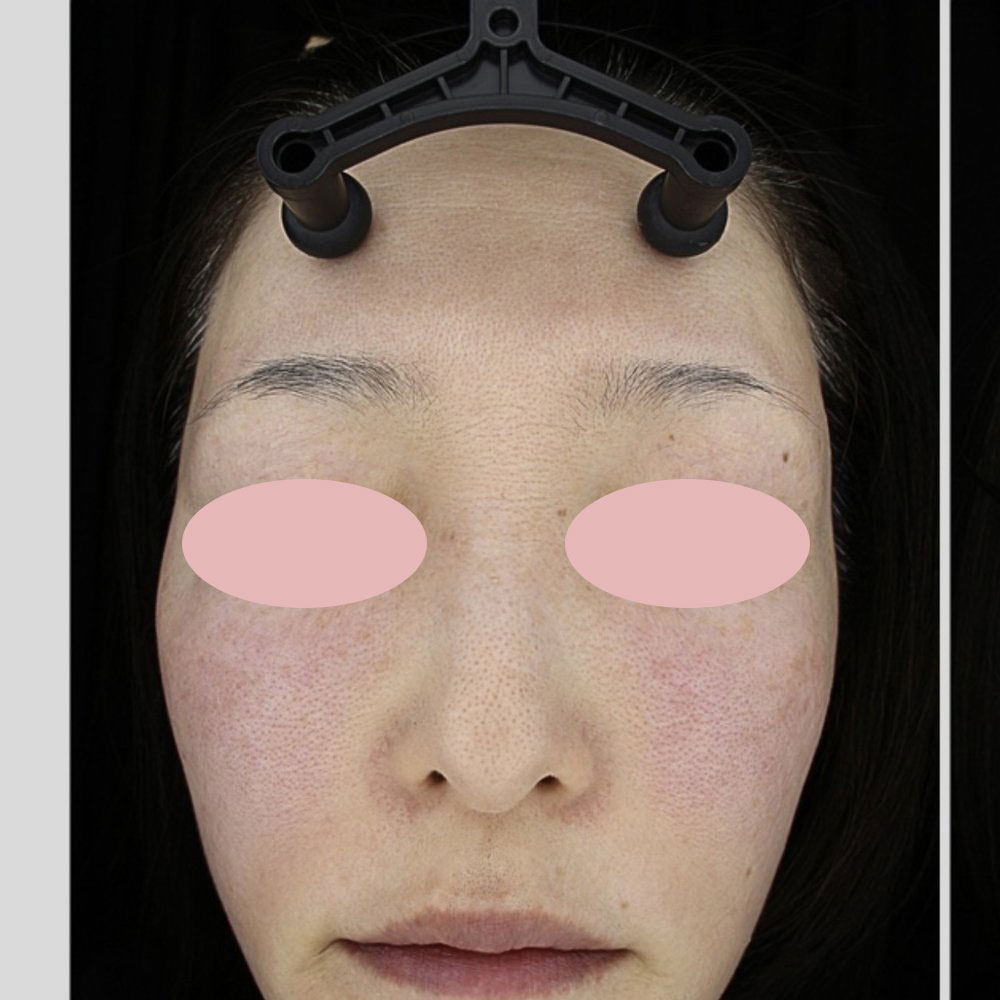 プルリアルデンシファイ（ハイコックス） 施術前