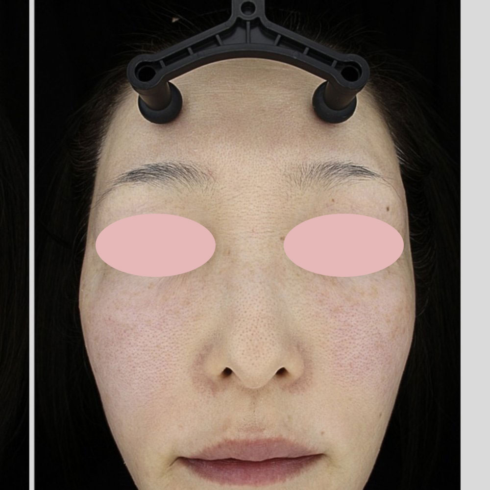 プルリアルデンシファイ（ハイコックス） 施術後