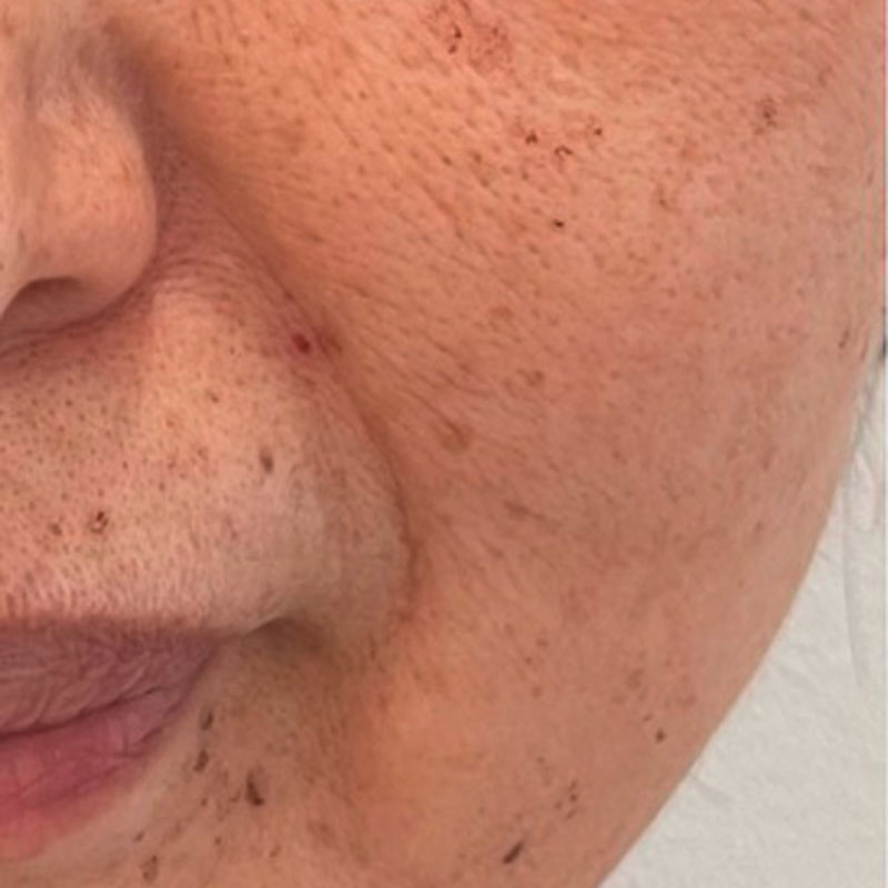 フォトフェイシャルM22（ドクター施術） 施術前