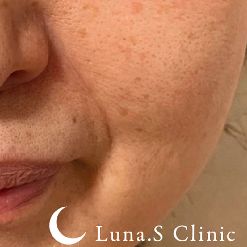 フォトフェイシャルM22（ドクター施術） 施術後