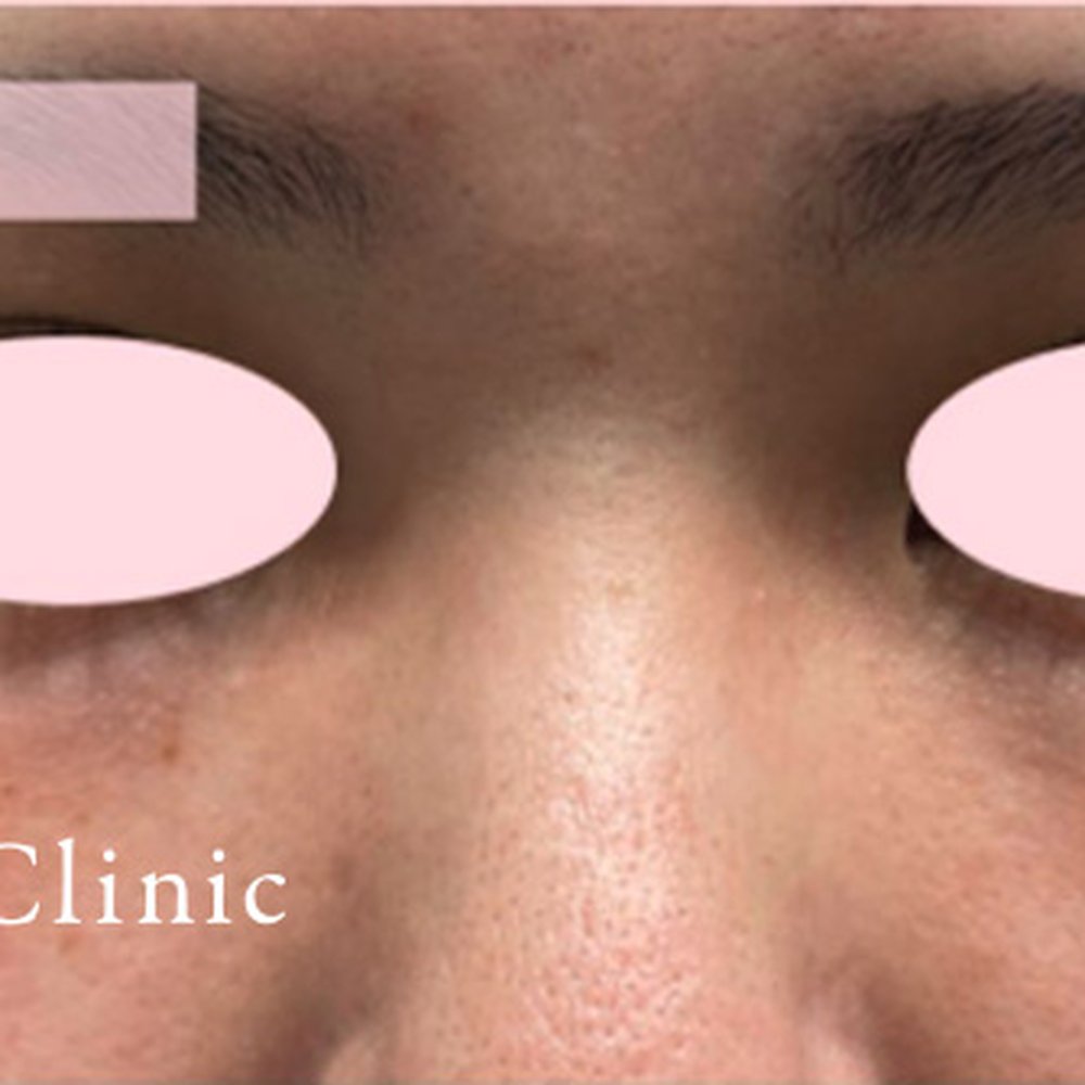 フォトフェイシャルM22（ドクター施術） 施術前