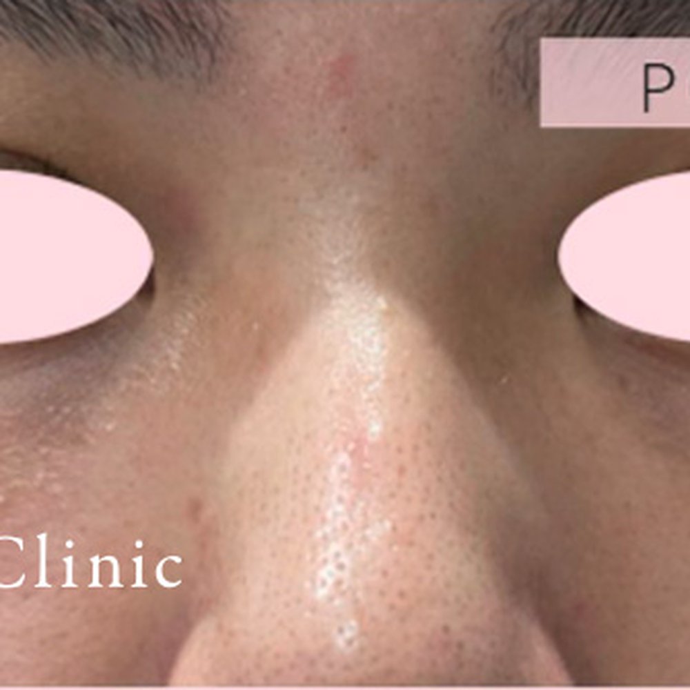 フォトフェイシャルM22（ドクター施術） 施術後