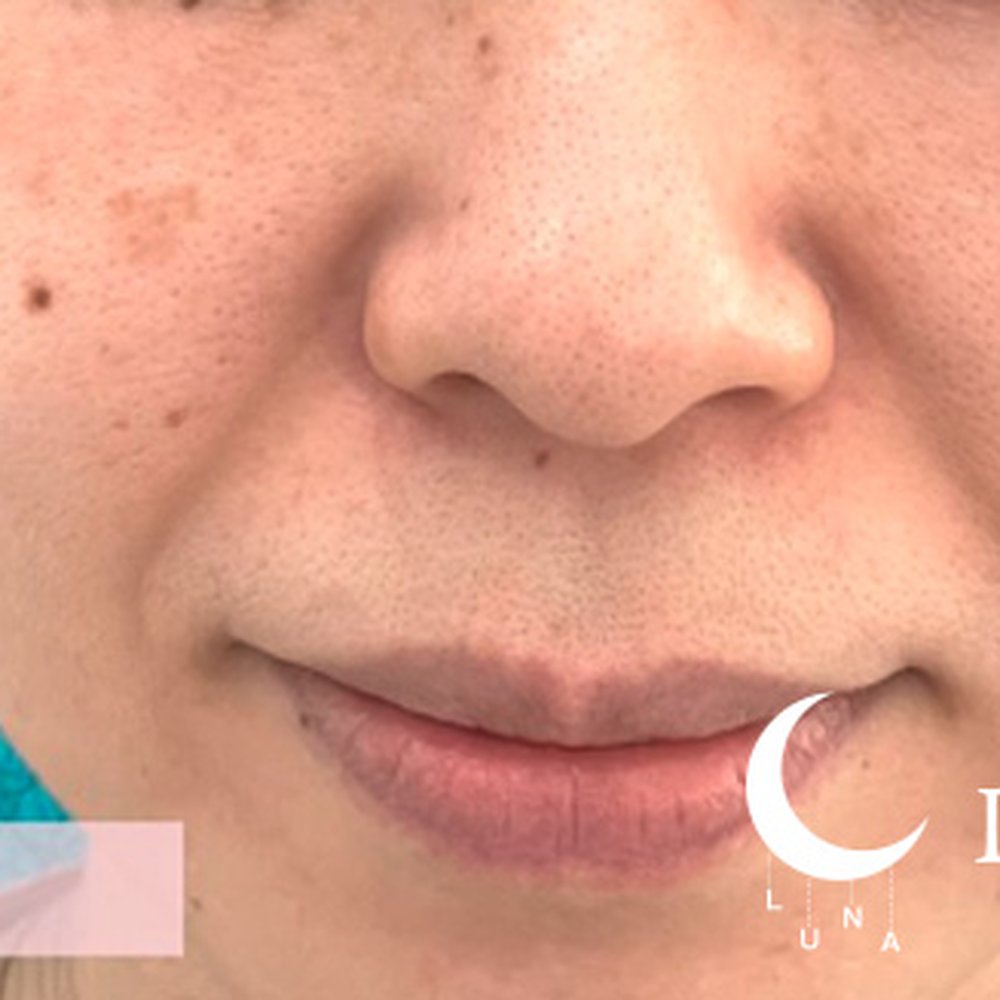 フォトフェイシャルM22（ドクター施術） 施術前