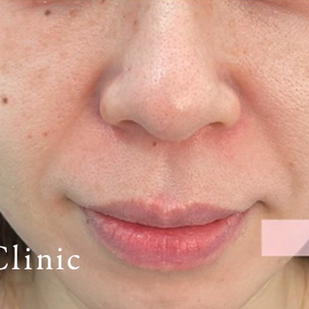 フォトフェイシャルM22（ドクター施術） 施術後