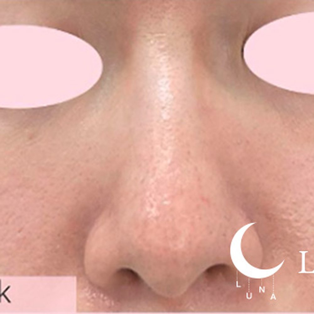 フォトフェイシャルM22（ドクター施術） 施術後