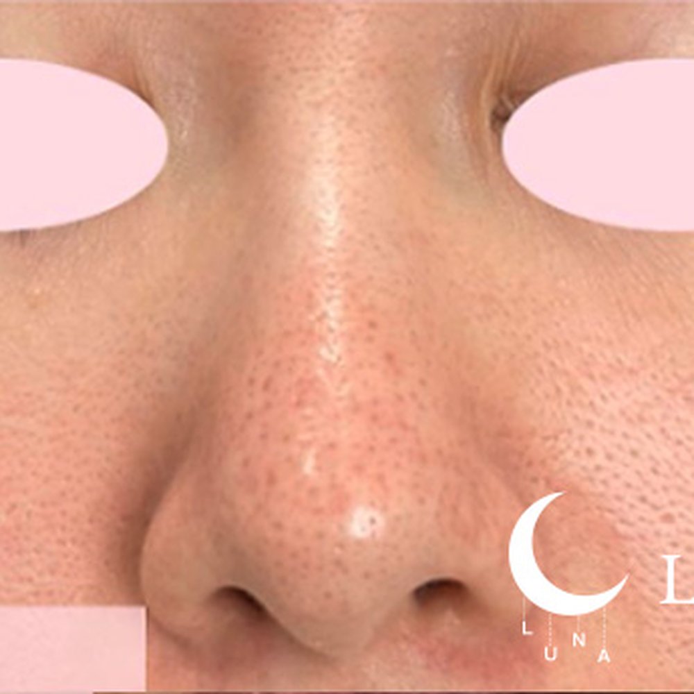 フォトフェイシャルM22（ドクター施術） 施術前