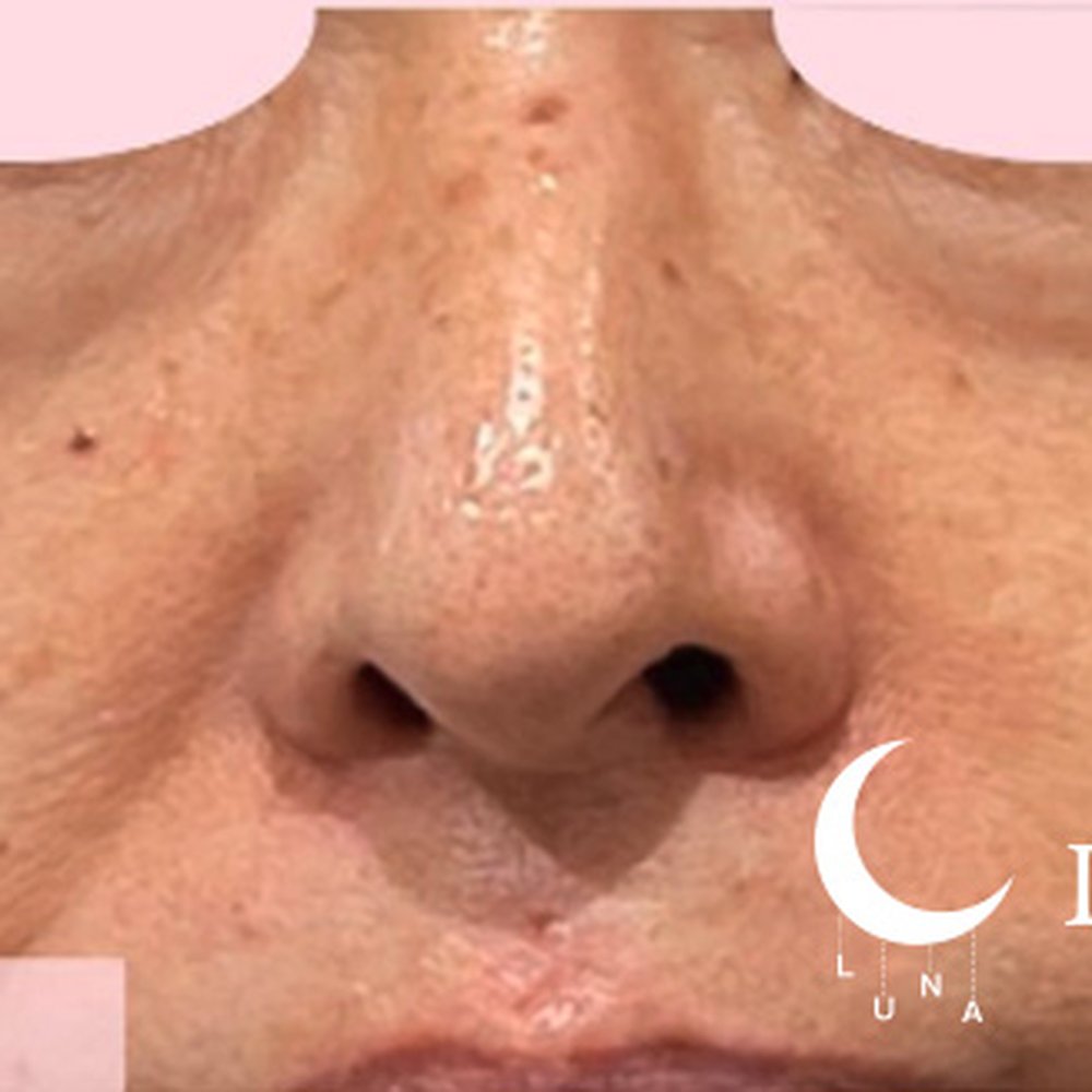 フォトフェイシャルM22（ドクター施術） 施術前