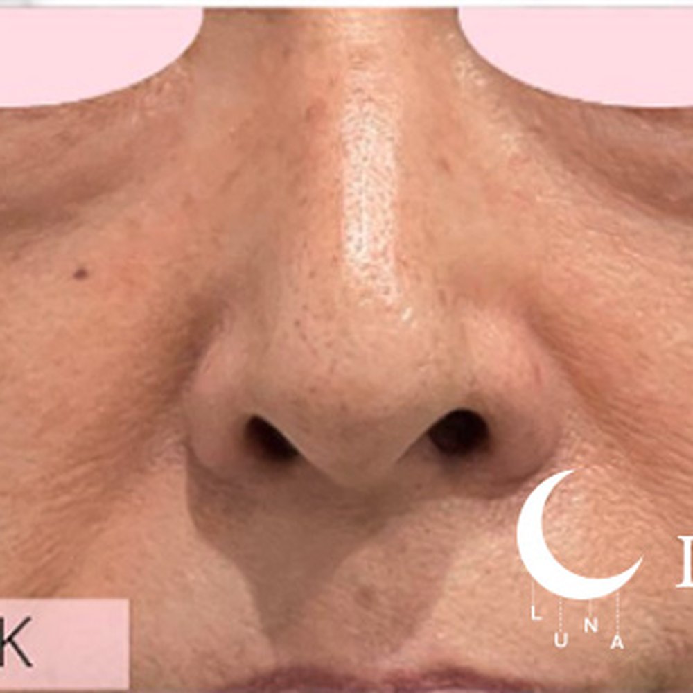 フォトフェイシャルM22（ドクター施術） 施術後