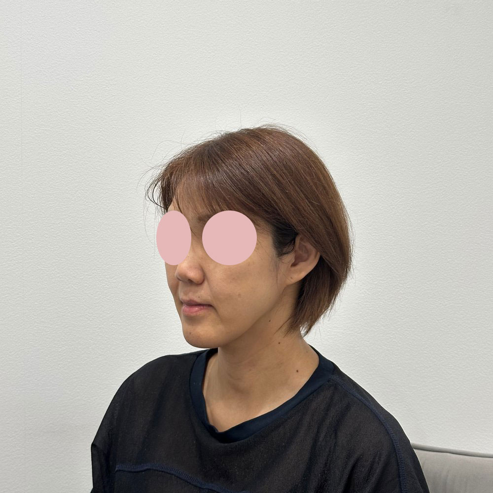 デンシティ＋ウルトラセルQプラス組み合わせ 施術前