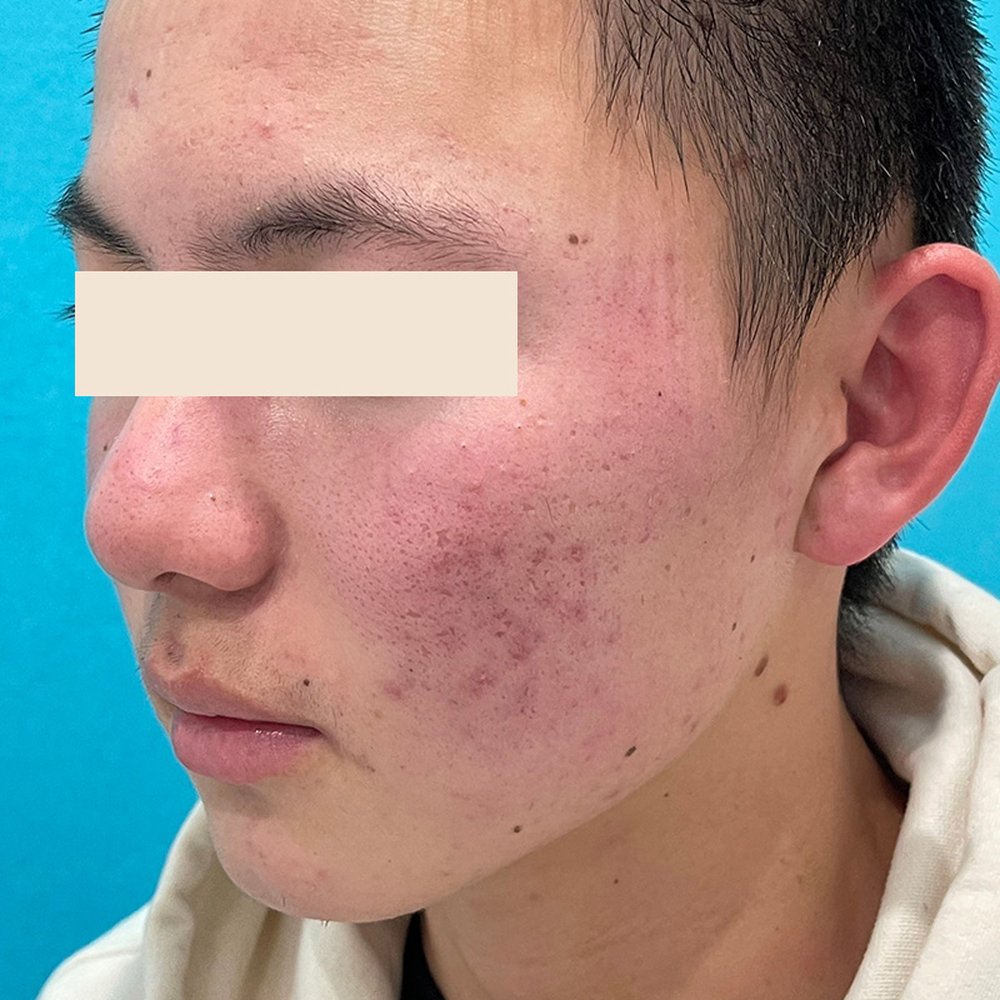 ダーマペン4（全顔） 施術前