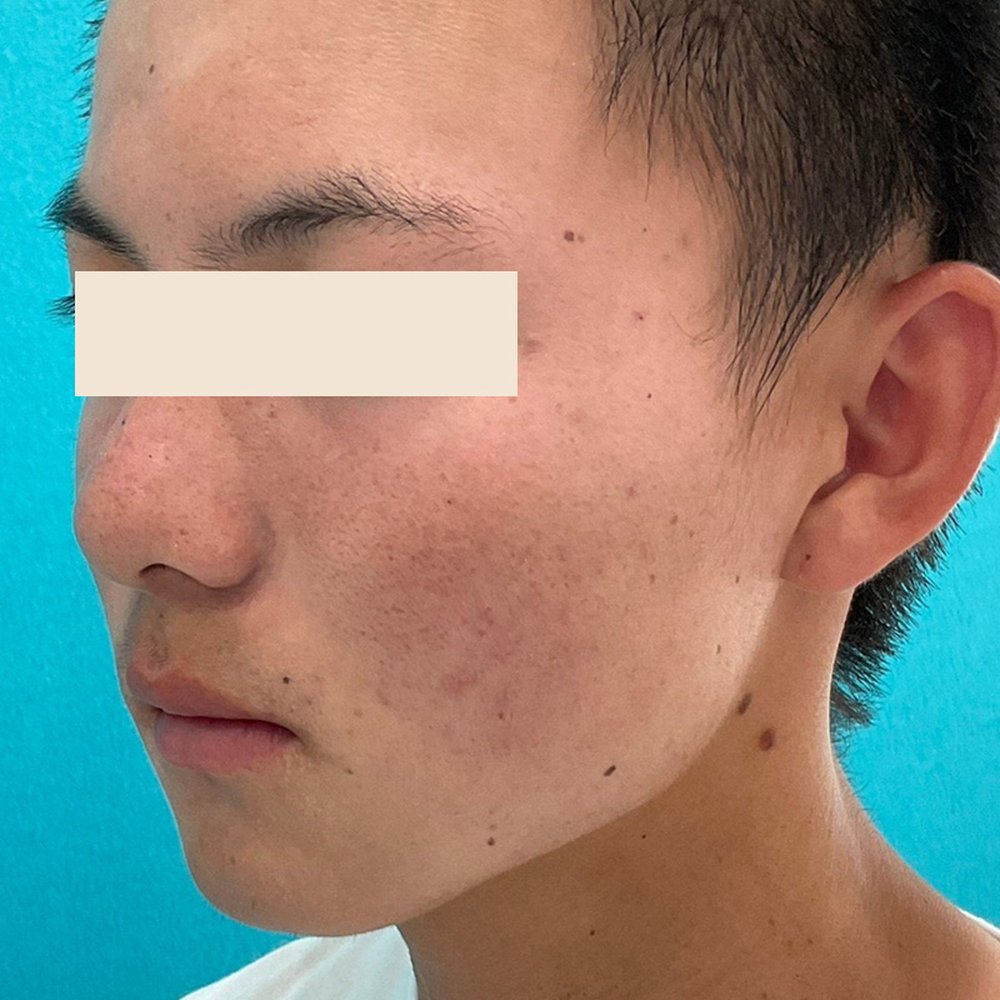 ダーマペン4（全顔） 施術後