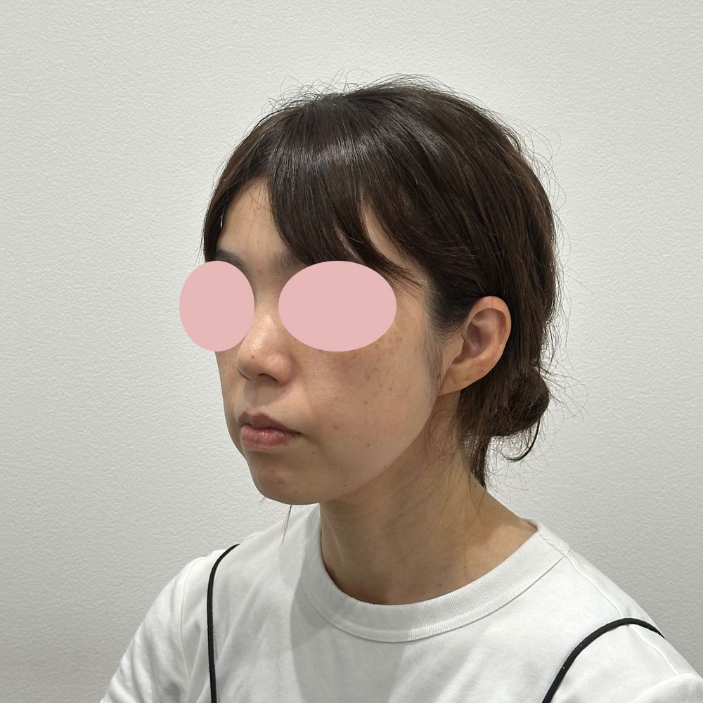 デンシティ＋ウルトラセルQプラス組み合わせ 施術前